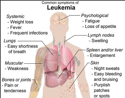 How Do Symptoms Leukemia Begin ?		